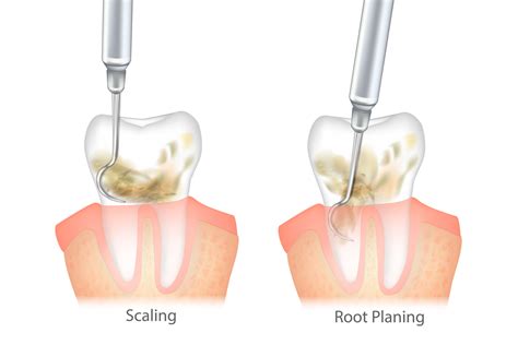 SRP and Osseous Surgery – Parkway Periodontics