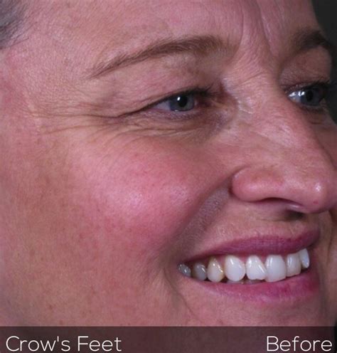 Crows Feet Anti-wrinkle Treatment Before - Facelove