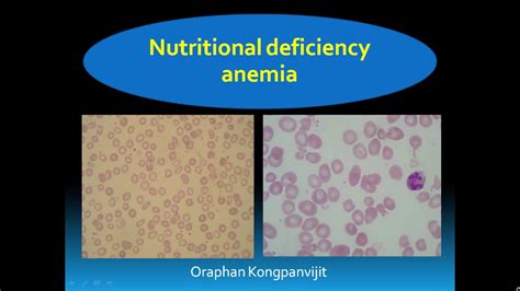 nutritional deficiency anemia - YouTube