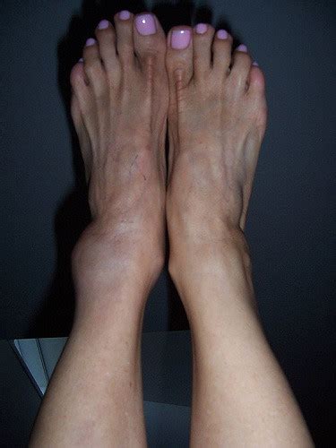 Ankle Dislocation: Treatment, Rehab & Recovery Time | Study.com