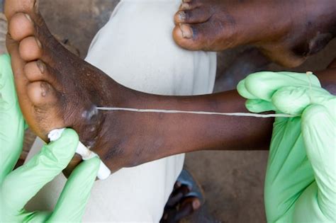 The world is closer than ever to eradicating Guinea worm - The Washington Post