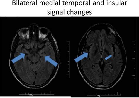 Medial temporal lobe signal changes in MRI. | Download Scientific Diagram