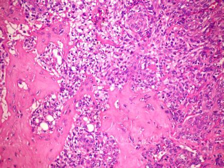 Pathology Outlines - Eccrine spiradenoma