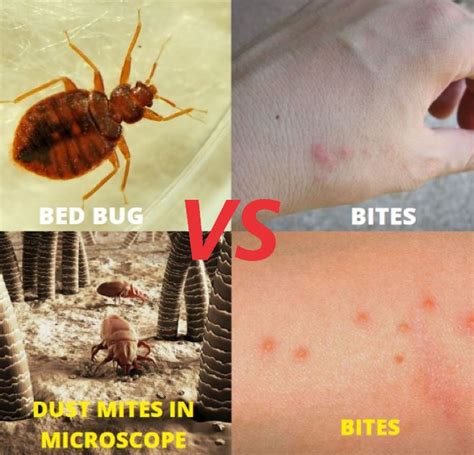 Dust Mite Bites Vs Bed Bug Bites What S The Differenc - vrogue.co