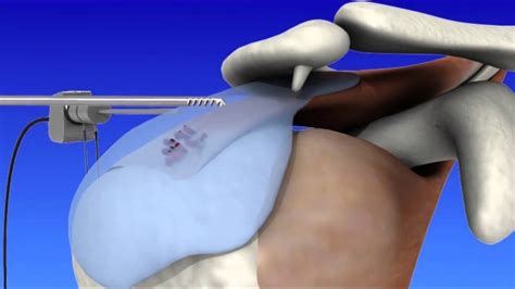 Shoulder Arthroscopy - YouTube