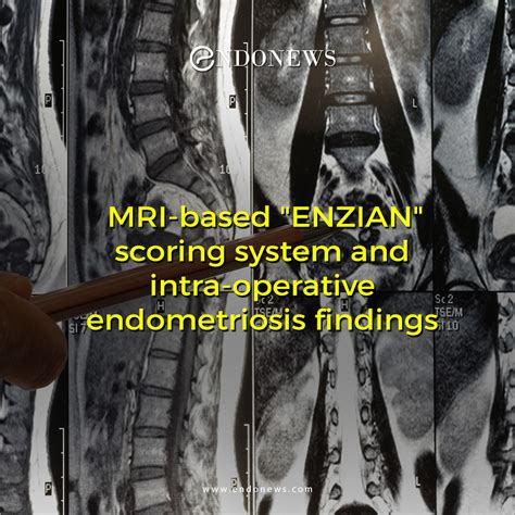 MRI-based "ENZIAN" scoring system and intra-operative endometriosis findings | EndoNews