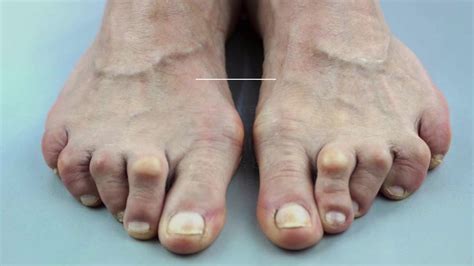 15 Signs & Symptoms of Foot Problems & What They Reveal About Your ...