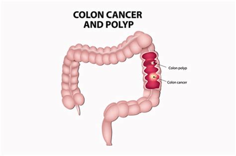 Post Colonoscopy Polyp Questions - American College of Gastroenterology