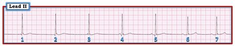 ECG Interpretation: ECG Blog #192 (ECG MP-9) — AV Dissociation by Usurpation – Default – AV Block?