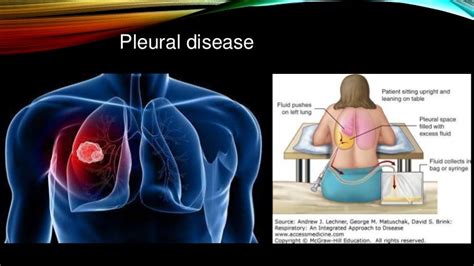 Pleural disease