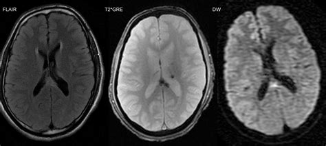 Dr Balaji Anvekar FRCR: Role of MRI Diffusion