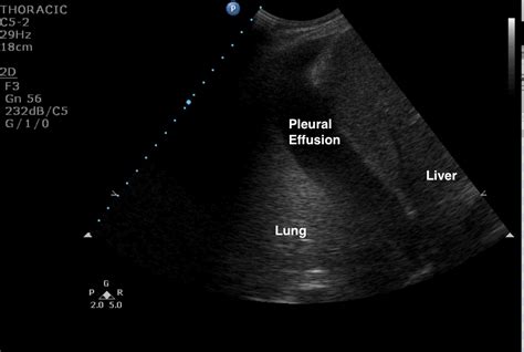 Ultrasound Diagnosis of Pneumonia | Emory School of Medicine