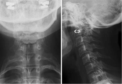 basilar invagination in osteogenesis imperfecta | Osteogenesis imperfecta, Chiari malformation ...