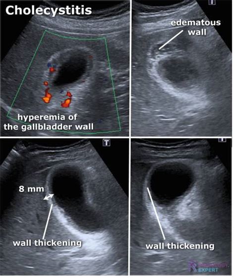 Gallbladder Ultrasound