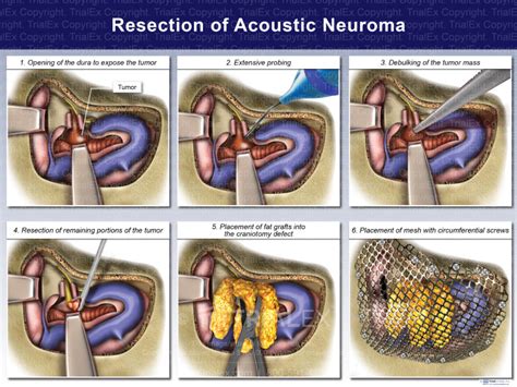 Resection of Acoustic Neuroma - TrialQuest Inc.