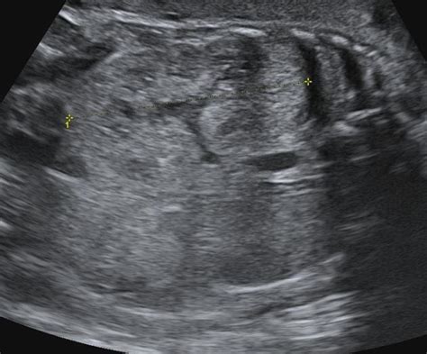 Infantile Polycystic Kidney Disease Ultrasound