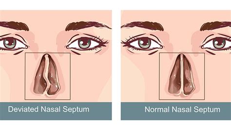 Deviated Septum - Sinus Surgery Center | UCI ENT | Sinus Surgery ...