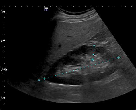 Renal Artery Stenosis Ultrasound