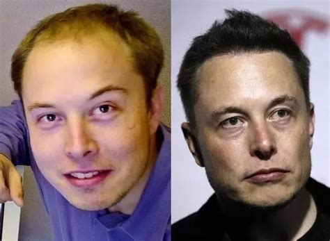 Elon Musk Hair Transplant: what was his secret of hair plug?