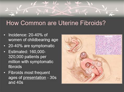 How Common Are Uterine Fibroids? - BrooklynFibroid.com