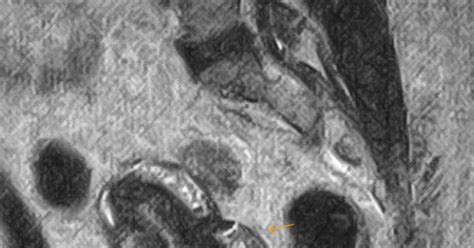 Adenomyosis-MRI - Sumer's Radiology Blog