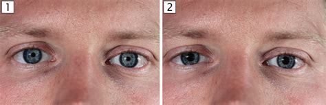 Dilated Pupils Vs Normal