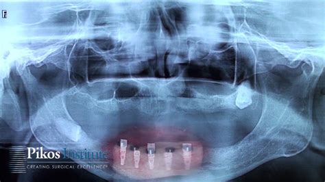 Preview: Video 7: Mandibular Vestibuloplasty with Alloderm® an... | Here's a preview from our ...