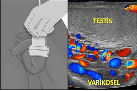 VARİKOSEL EMBOLİZASYONU NEDİR?