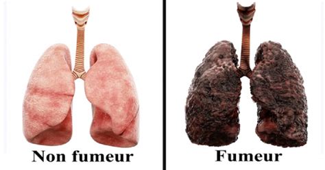 Une infirmière explique ce que le tabac fait tous les jours à vos poumons ~ Santé Nutrition