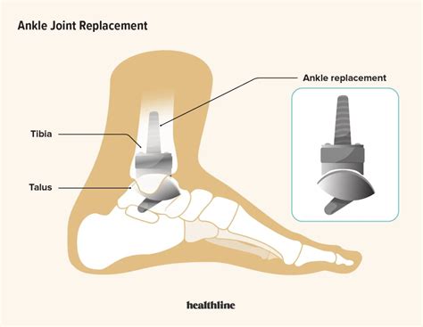 Ankle Joint Replacement: Procedure, Recovery, and FAQs - Austra Health