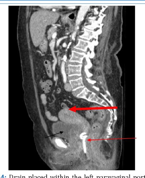 Figure 4 from Management of pyometra after Lefort colpocleisis ...