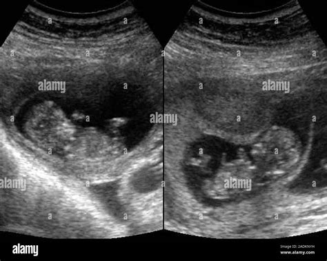 Twin foetuses. Ultrasound scan of twin foetuses in the first trimester of pregnancy. Non ...