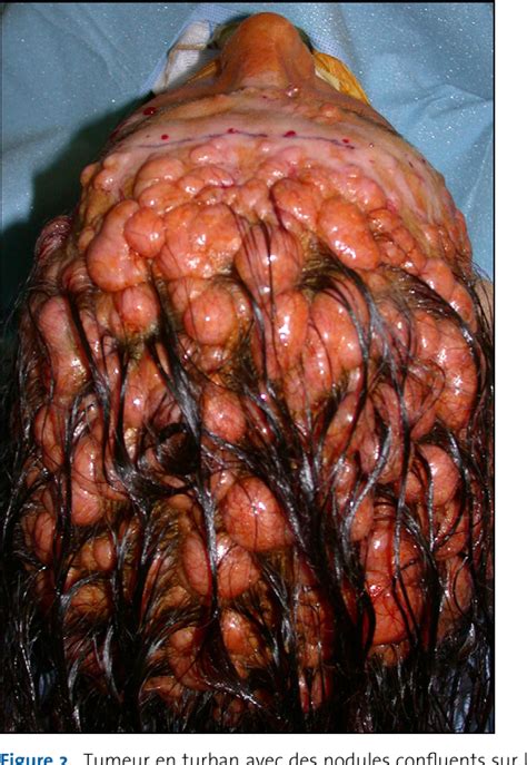 Figure 2 from [Management of whole-scalp tumour: the Poncet-Spiegler ...