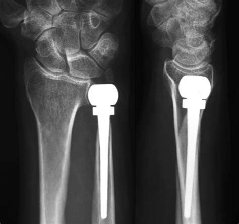 Distal Ulna Fractures - Journal of Hand Surgery