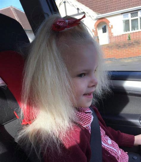 Uncontrollable Hair Syndrome: Girl, 9, finally able to have her hair ...