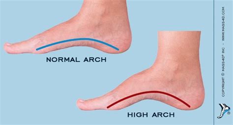 Orthotic Therapy for the Pes Cavus Foot