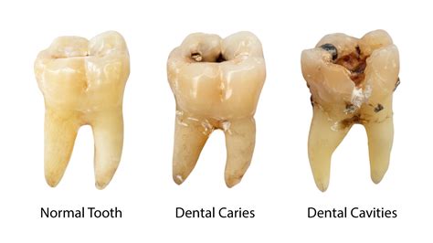 Get the Facts about Cavities with Your Dentist in Bothell