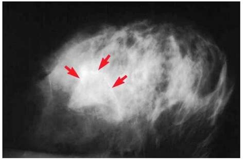 mammogram showing calcifications – Dr. Cate