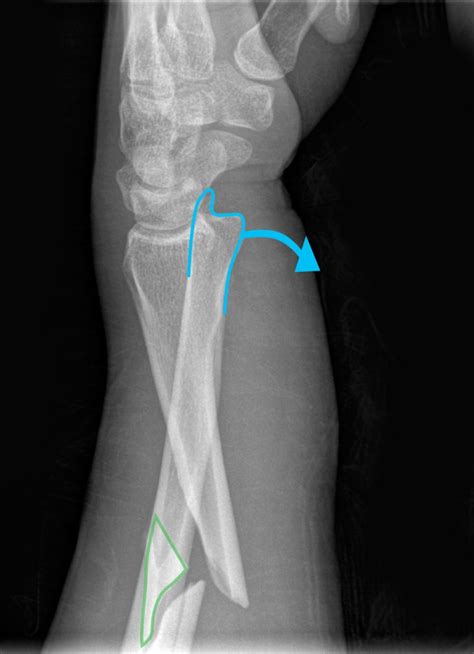 Galeazzi fracture-dislocations