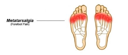 Metatarsalgia - Physiopedia