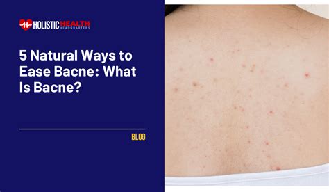 Banish Bacne Naturally: 5 Effective Ways to Ease Back Acne