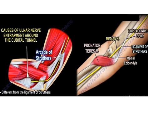 Cubital Tunnel Syndrome — OrthopaedicPrinciples.com