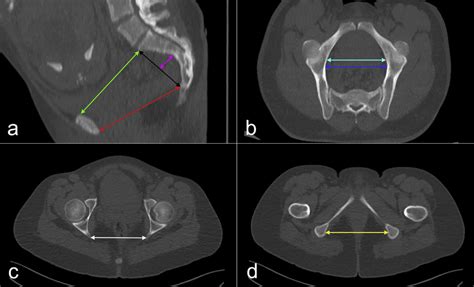 Measurement of pelvic diameters using computed tomography. The measures ...