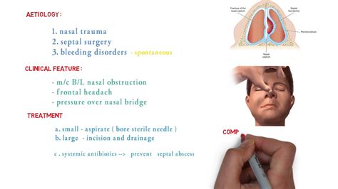 Nasal Septal Hematoma Wikipedia, 52% OFF