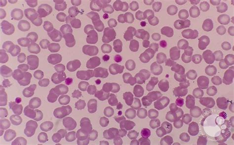 presence of giant platelets in peripheral blood sample 1