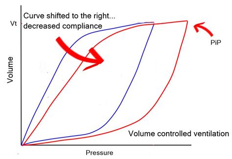 Mechanical Ventilation Series- Pressure/Volume loop….. - Critical Care Practitioner