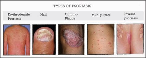 Psoriasis Specialty Treatment Center : Types