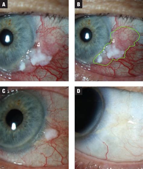 Is That Conjunctival Lesion Cancerous?