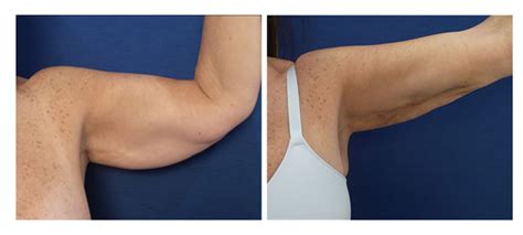 The Ultimate guide to high definition arms with HD Liposuction