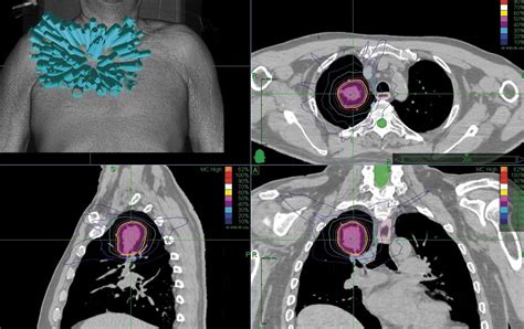 SBRT revolution in lung radiotherapy - Medical Forum